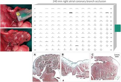 Changes in Local Atrial Electrograms and Surface ECG Induced by Acute Atrial Myocardial Infarction